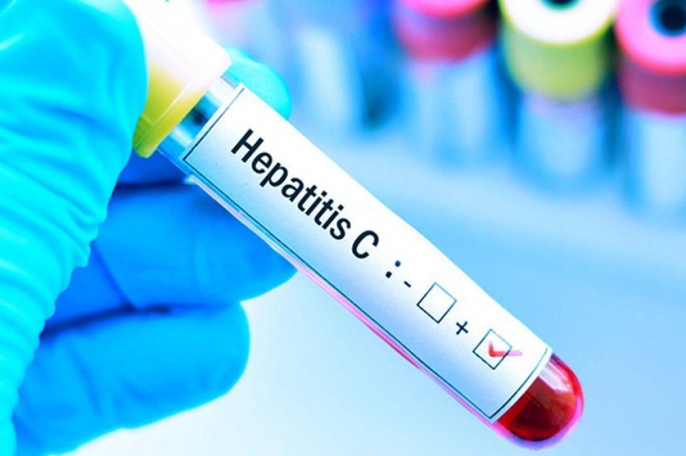 hepatitis c